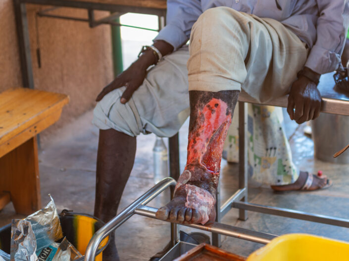 PASPANGA • Il Lebbrosario di Ougadougou