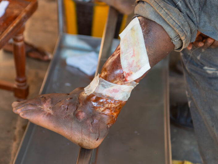 PASPANGA • Il Lebbrosario di Ougadougou