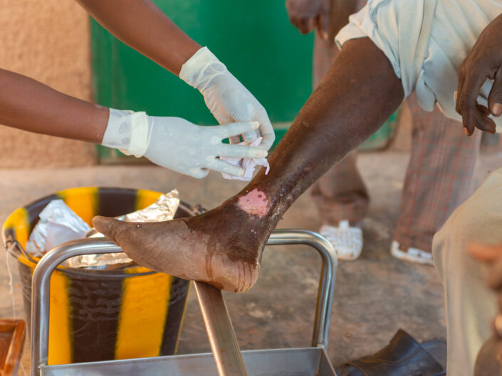 PASPANGA • Il Lebbrosario di Ougadougou