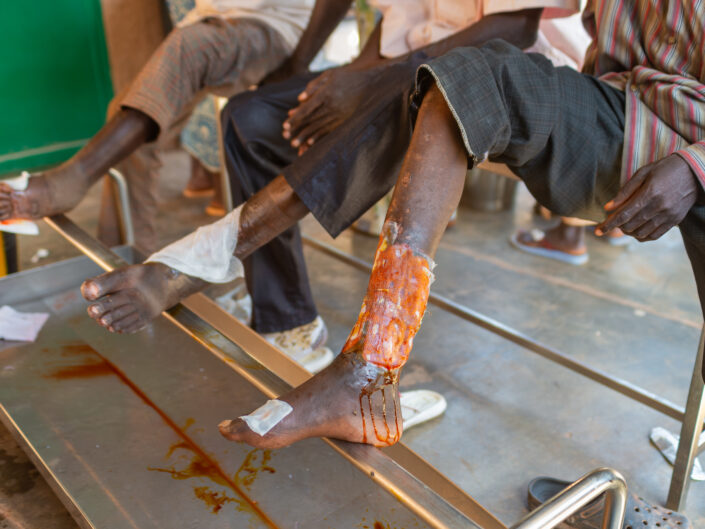 PASPANGA • Il Lebbrosario di Ougadougou